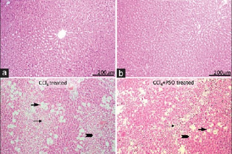 Histological analysis of the livers in carbon tetrachloride‑induced acute hepatotoxicity; Normal appearance of the livers of the control (a) and pomegranate seed oil‑treated (b) groups. The appearance of micro (arrowheads)‑ and macro (black thick arrows) vesicular fat vacuoles in all parenchyma and increased numbers of infiltrating mononuclear cells (black thin arrows), consisting predominantly of lymphocytes in carbon tetrachloride (c), and carbon tetrachloride + pomegranate seed oil‑(d) treated groups, Li