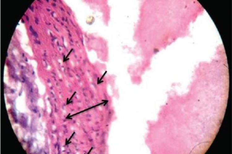 Atheromatous lesion showing intimal thickening, multiple foam cells in high cholesterol diet‑fed rat’s aorta (×400)